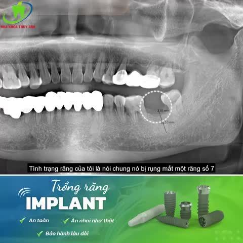 TRỒNG IMPLANT AN TOÀN, TRÁNH TIÊU XƯƠNG TỤT NƯỚU
